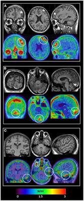 Tau PET following acute TBI: Off-target binding to blood products, tauopathy, or both?